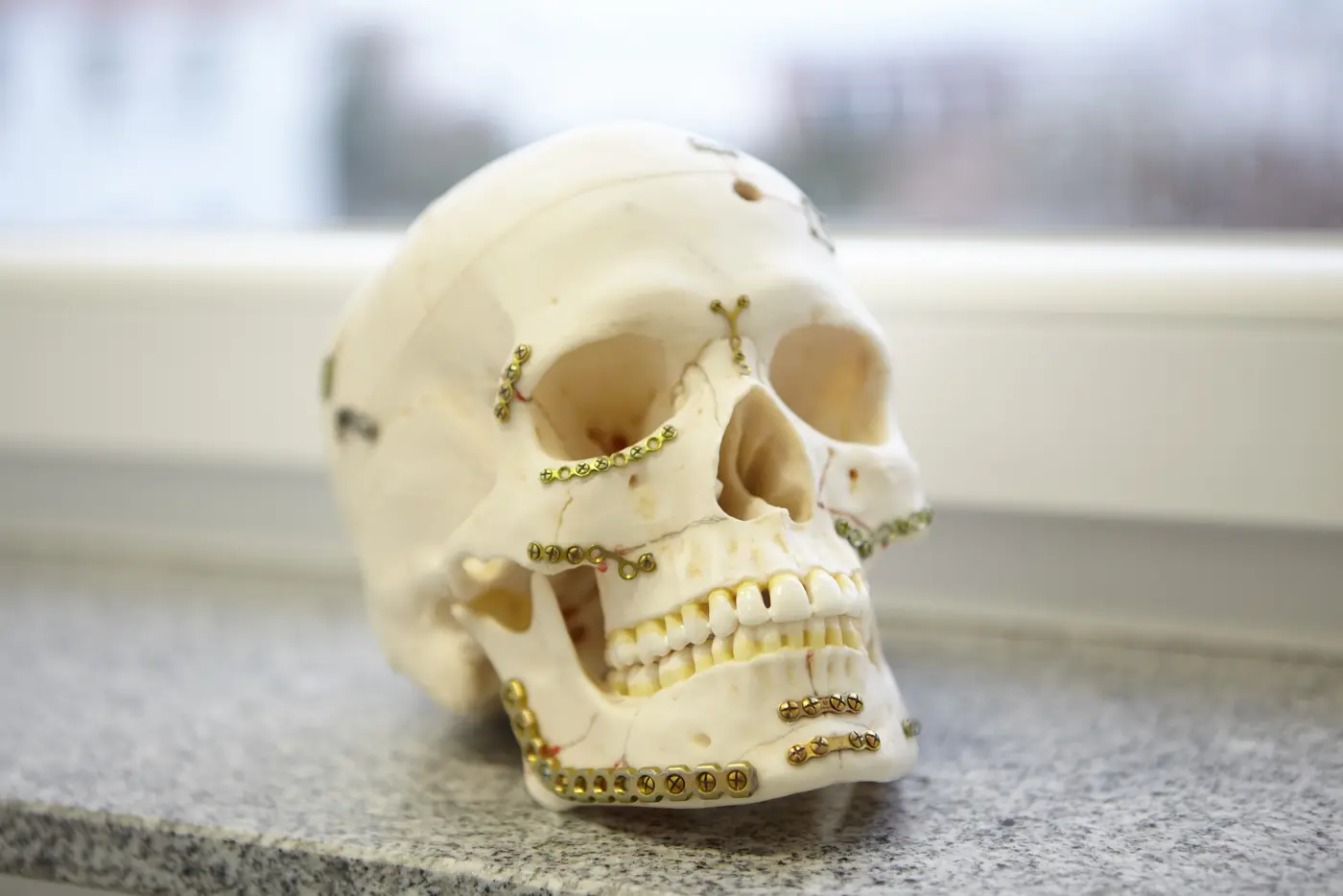 Anatomisches Schädelmodell mit Osteosyntheseplatten aus der Mund-Kiefer-Gesichtschirurgie
